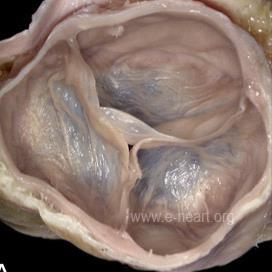 OSTIUM TRUNCI PULMONALIS truncus pulmonalis szájadéks vénás vért vezeti a truncus