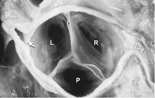 SINUS AORTAE (VALSALVAE) az aorta billentyű feletti részének a kiboltosulása innen