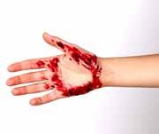 Sérülések Vérzések A kültakaró sérüléseit több szempontból is csoportosíthatjuk. Az egyik ilyen lehetőség, ha a vérzés intenzitását vesszük figyelembe.