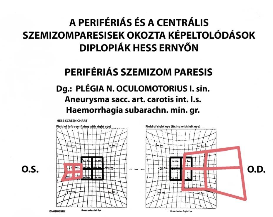 Differenciál diagnózis Perifériás paresis nagy kép diszparáció legnagybb PD-val sem krrigálható Th.