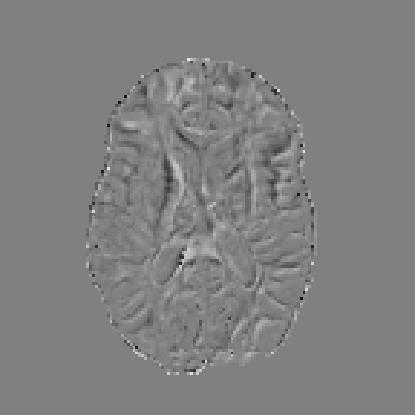 difference compared to the base image if 800 s/mm 2. There is very little ordered difference between 800 s/mm 2 and 1600 s/mm 2, while both 1200 and 2400 show a difference.