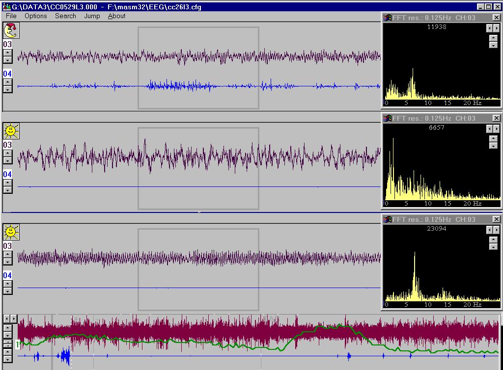 Fourier-analízis Vigilanciaállapotok