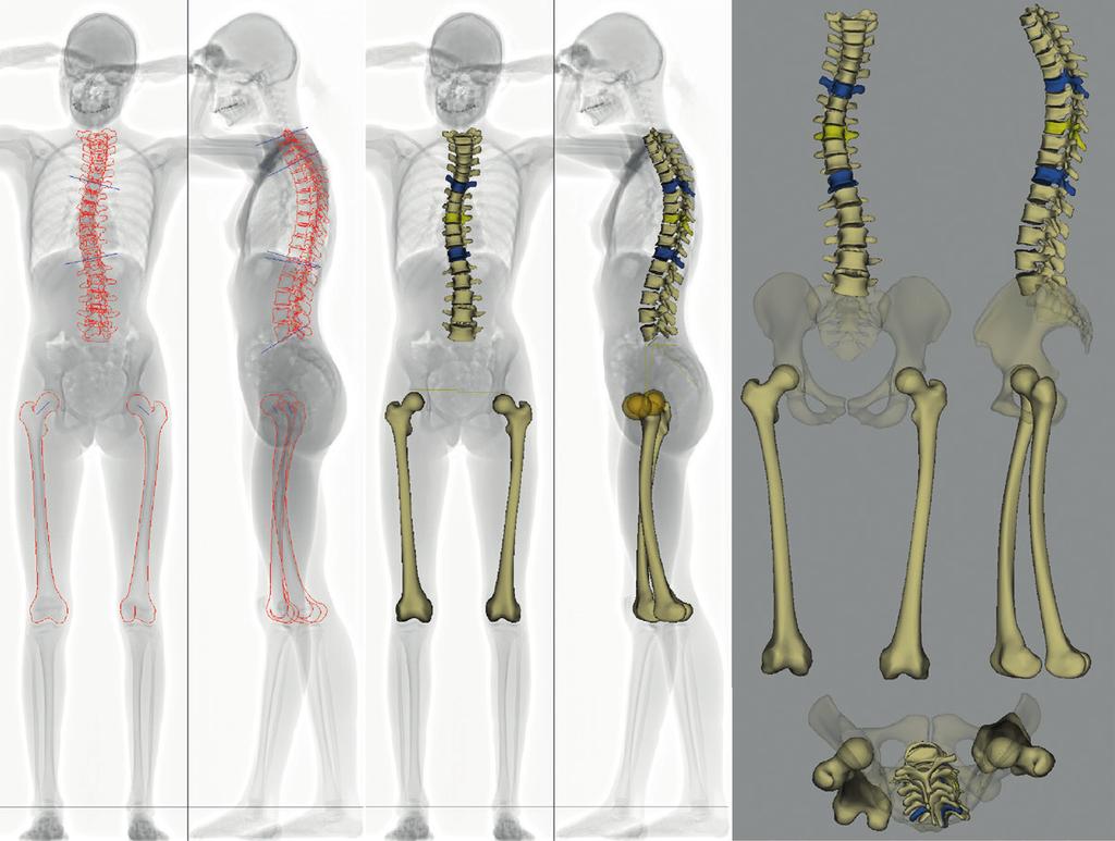 1. ábra KK, 13 éves lány gyermek gerinc és mindkét oldali combcsont teljes felszíni rekonstrukcióját mutatja. A jobbra konvex háti görbület a T6 T9 T12 csigolyák között áll fenn.