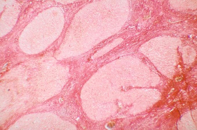 Progressziv fibrosis pseudolobularis átépülés >> parenchymás / vasculáris decompensatio Makroszkópia: mikro - /