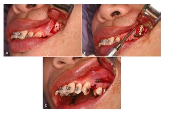 MINILEMEZEK Contemporary Orthodontics, 5th Edition, by William R.