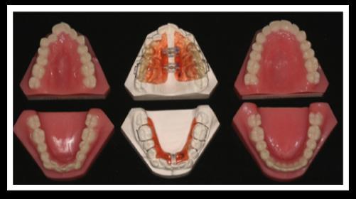 DENTOALVEOLÁRIS FOGÍVSZŰKÜLET