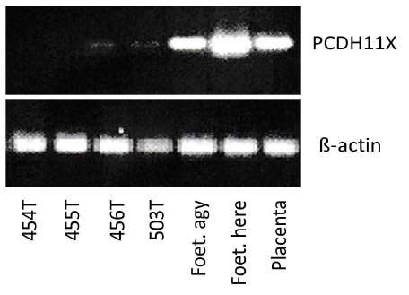 vese sejtekben (1561N) mind a 147 bp (X kromoszóma) és a 134 bp (Y kromoszóma) is megfigyelhető. Mind a PCDH11Y és PCDH11X génnek számos izoformája ismert.