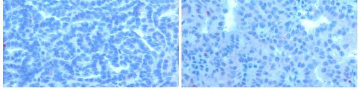 Papilláris vesetumor eredete Mintegy 25 évvel ezelőtt javaslat született a papilláris vese tumorok embrionális maradványokból való kiindulására (Kovacs és Kovacs, 1993; Kovacs 1993a,b).