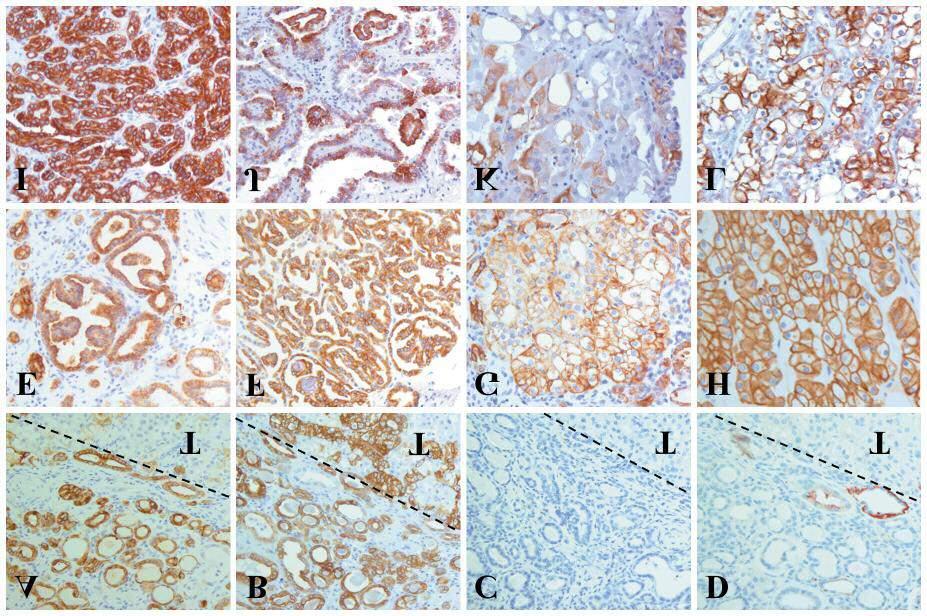 A pre-neoplastic lesion showing a transition from small-cell papillary morphology towards large eosinophilic cells (C) and the ACRD-associated vacuolated eosinophil tumor (D) of the same kidney.