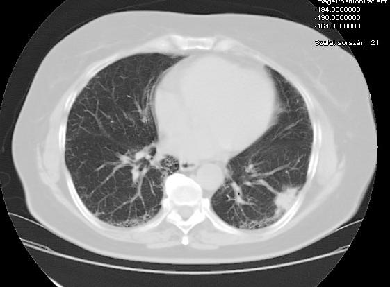 Kivizsgálás Endobronchialis eltérés nem volt. Mikrobiológia tenyésztés negatív. BAL: kevert sejtösszetételt igazolt, lymphocytosis hiányával. TBTB és kefecytol.: planocellularis carcinoma gyanúja.