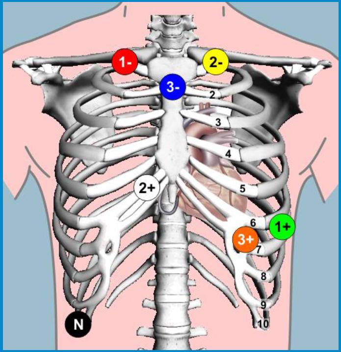 3.2 ECG Electrocardiogram numbers, there are positive or negative signs, which show that the channels are bipolar, namely the ECG signs can be mirrored if the electrodes are replaced.