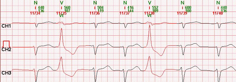 3 Biomedical signal processing Cardiospy can classify heartbeats.