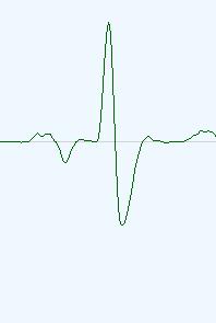 3.2.5.1 Input data 3.2 ECG Electrocardiogram Figure 26 shows a part of a three channel ECG recording. Normal heartbeats are marked with N, ventricular heartbeats with V.