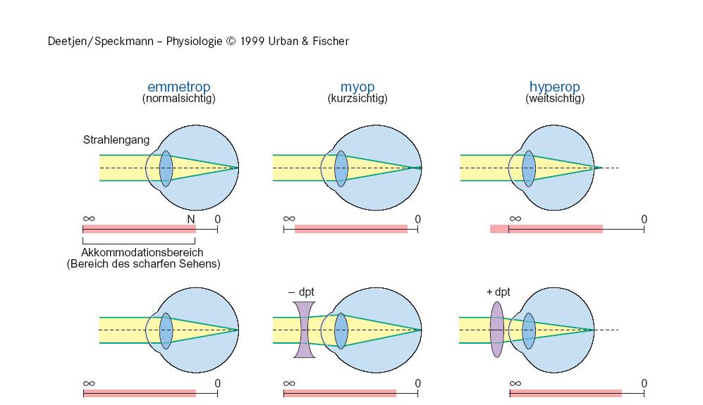 fénysugár emmetropia (egészséges) Töréshibák myopia (rövidlátó)