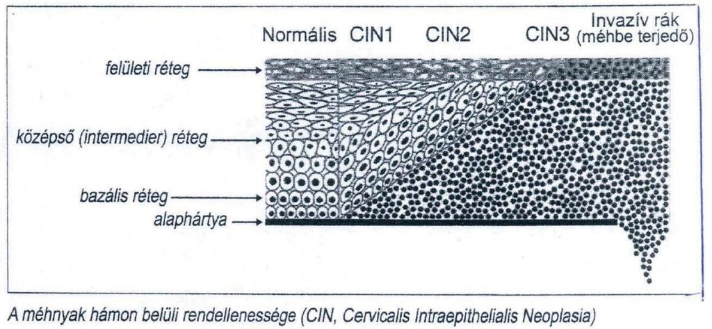 befelé, a nyakcsatornába áthelyeződik. Az átmeneti zóna mozgásában hormonális hatások játszanak szerepet. A rákmegelőző állapotok elnevezés alatt fokozódóan súlyos hámelváltozásokat értünk.