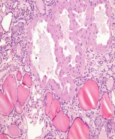 Glomerulo-szklerozis Tubuláris