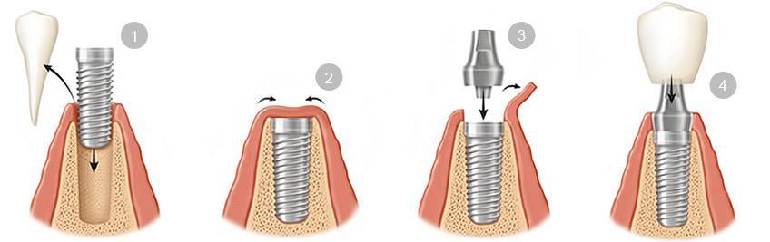 Dentális implantátum beültetési módjai Az oralis enossalis implantáció elvégzéséhez többtagú csapat szükséges, melynek tagjai: protetikus fogorvos, szájsebész, fogtechnikus.
