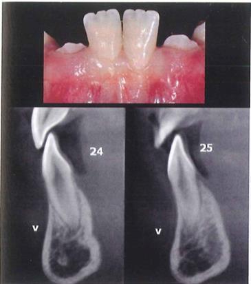 Parodontológiai célkitűzések a fogszabályozó kezelés tervezésénél Funkció: fogak a kezelés végén csontban legyenek