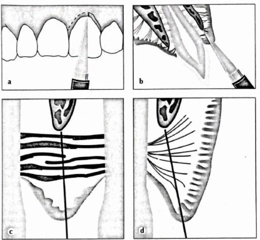 Fiberotómia - CSF rotált fogak relapszusának csökkentésére supracrestális elasztikus rostok Edwards: CSF C ircumferential S upracrestal F iberotomy