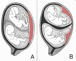Az egypetéjű ikrek embriói azonos neműek és egyetlen méhlepényen osztoznak. Egyetlen külső membrán veszi körül mindkét magzatburkot.