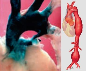 2. ábra A velősánc-eredetű sejtek festődése emlősben a ligamentum arteriosum szintjéig tart 27 Az aorta ascendens és az aortaív, illetve a thoracoabdominalis aorta érszakaszain megjelenő aneurizmák