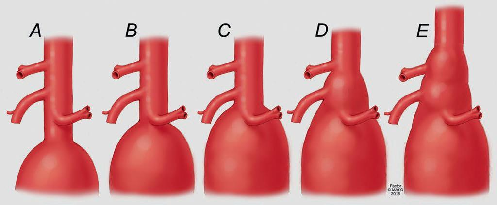 3. ábra A hasi tágulatok osztályozása a proximalis nyak alapján 16 Az ágakhoz való viszony alapján elkülönítünk infrarenalis (A), juxtarenalis (B), pararenalis (C), paravisceralis (D), ill. IV.