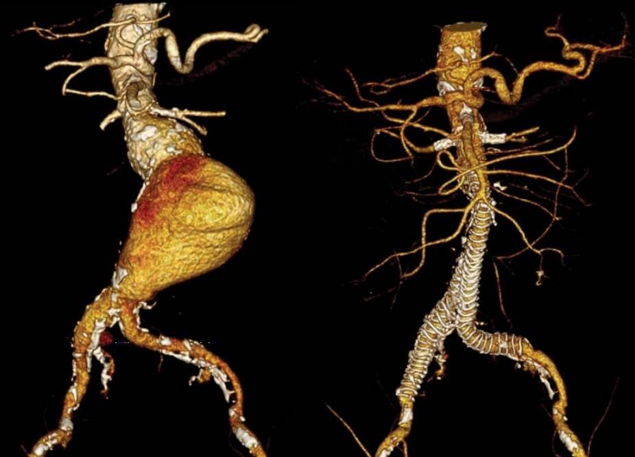 13. ábra Két arteria renalis és a mesenterica superior fenesztrációjával megoldott juxtarenalis aneurizma esete (saját anyag) A juxtarenalis aorta aneurizma, illetve a mesenterica superior és a