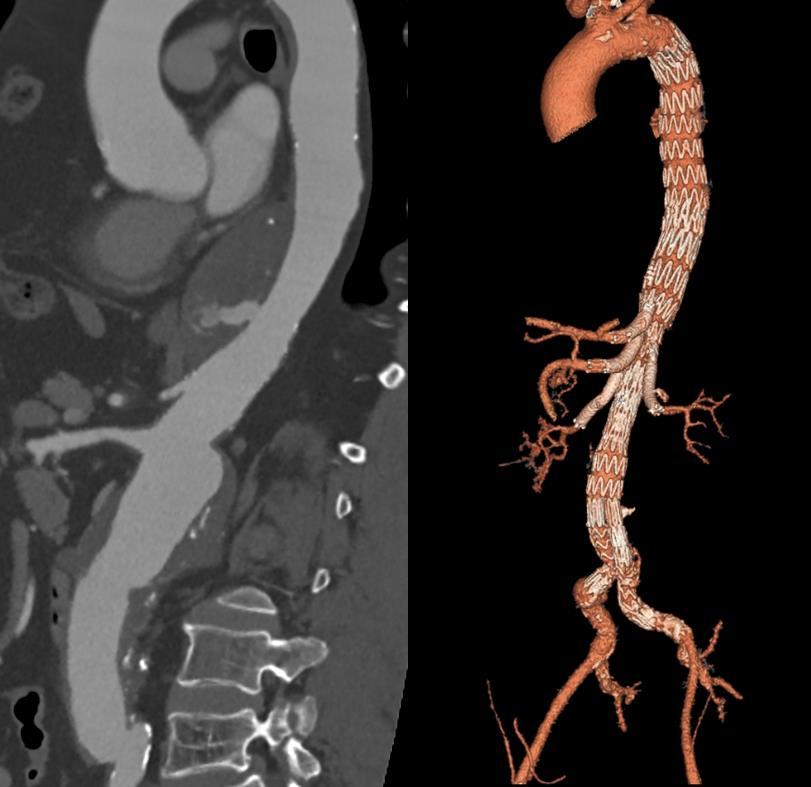 14. ábra Aorta descendens és paravisceralis aneurizma megoldása Cook t- Branch eszközzel (saját anyag) A korábban aorto-biiliacalis bypass műtéten átesett betegnél a thoracoabdominalis átmenetben,
