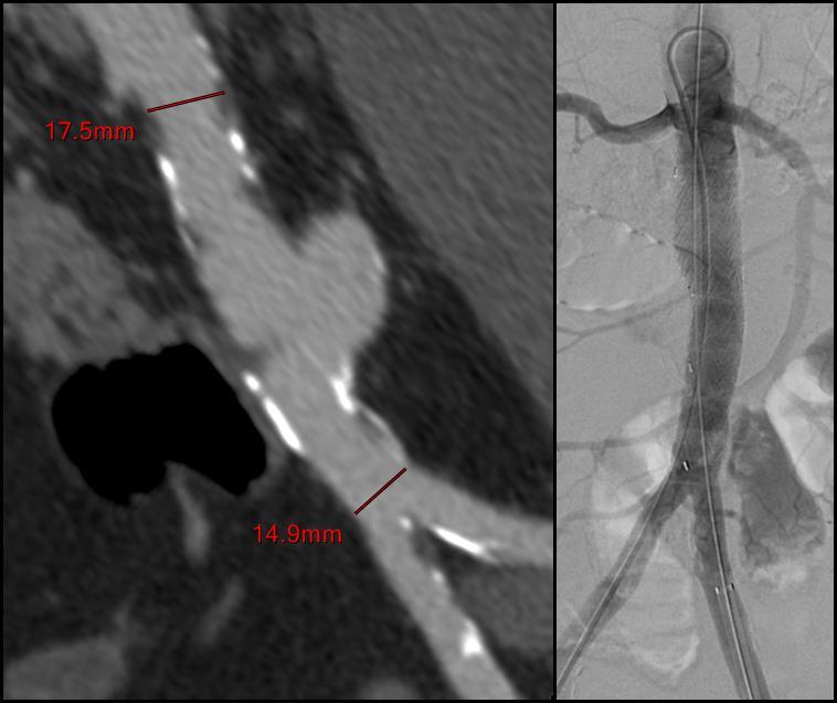 23. ábra Orvos által módosított graft implantációja az infrarenalis aortán (saját anyag) Az infrarenalis aorta rövid szakaszát érintő saccularis aneurizma (bal oldalon) optimális megoldása egyenes