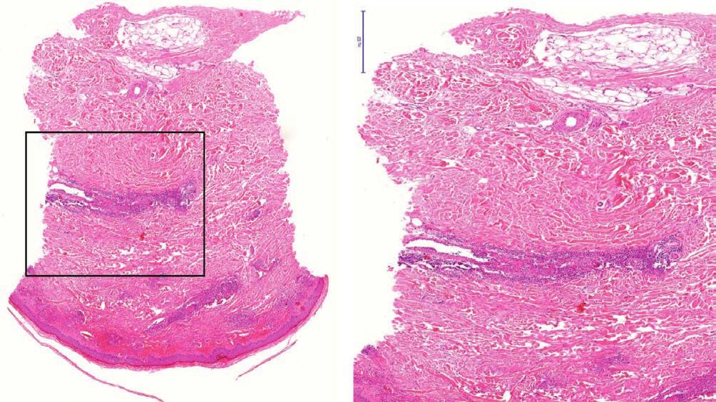 2. ábra A biopsziás mintában a dermis superficiális és középső zónájában lévő kisereit is érintve leukocytoclasticus vasculitis azonosítható, érfalnecrosissal, extravasatióval, fibrinkiválással,