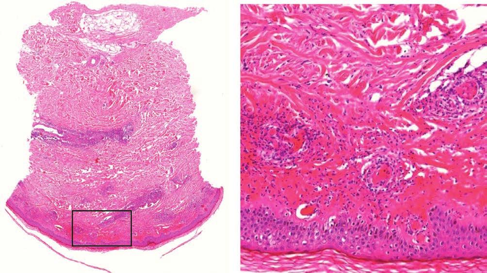 Bár manifeszt granulomatosus jelleget nem detektáltunk, a szöveti kép a klinikai tünetek és diagnosztikus eltérések alapján támogatta EGPA fennállását a bőrtüneti gyorsan szanálódtak, a neurológiai