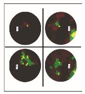 Ocularis Stroke - AKUT fázisában Terápiás protokoll javaslat SBO -, CARDIO-, / CEREBROVASCULARIS INTENZÍV EGYSÉGEKBEN Beavatkozási jellege Therapiás protokoll 1./ THROMBOLYSIS 2.