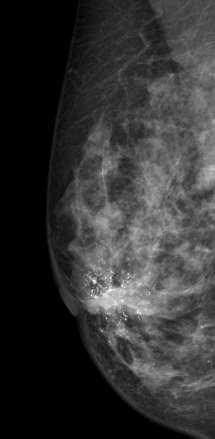 DCIS mammográfia alapján