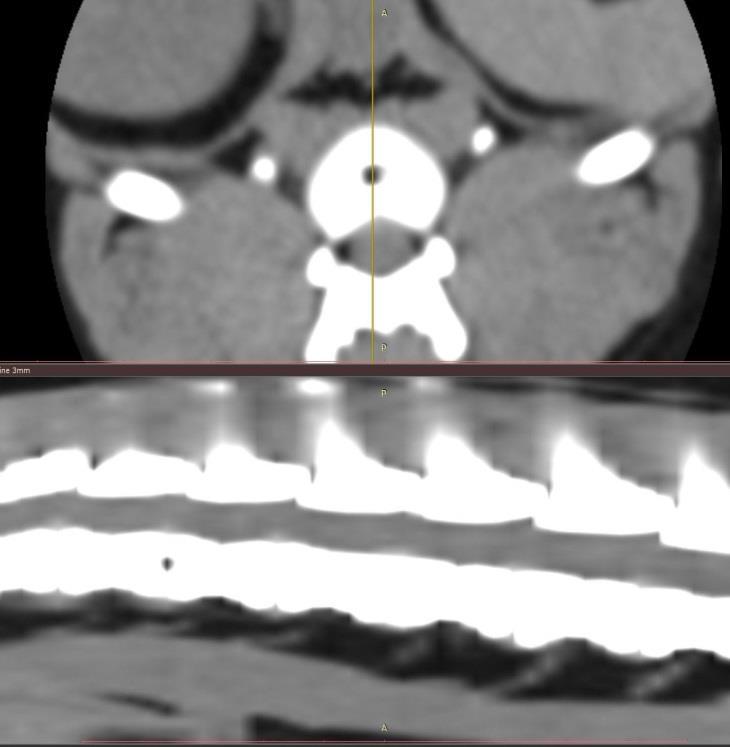 alkalmával discus hernia (n=7), tumor (n=1) és haematoma (n=1) kompressziós hatása került megállapításra.