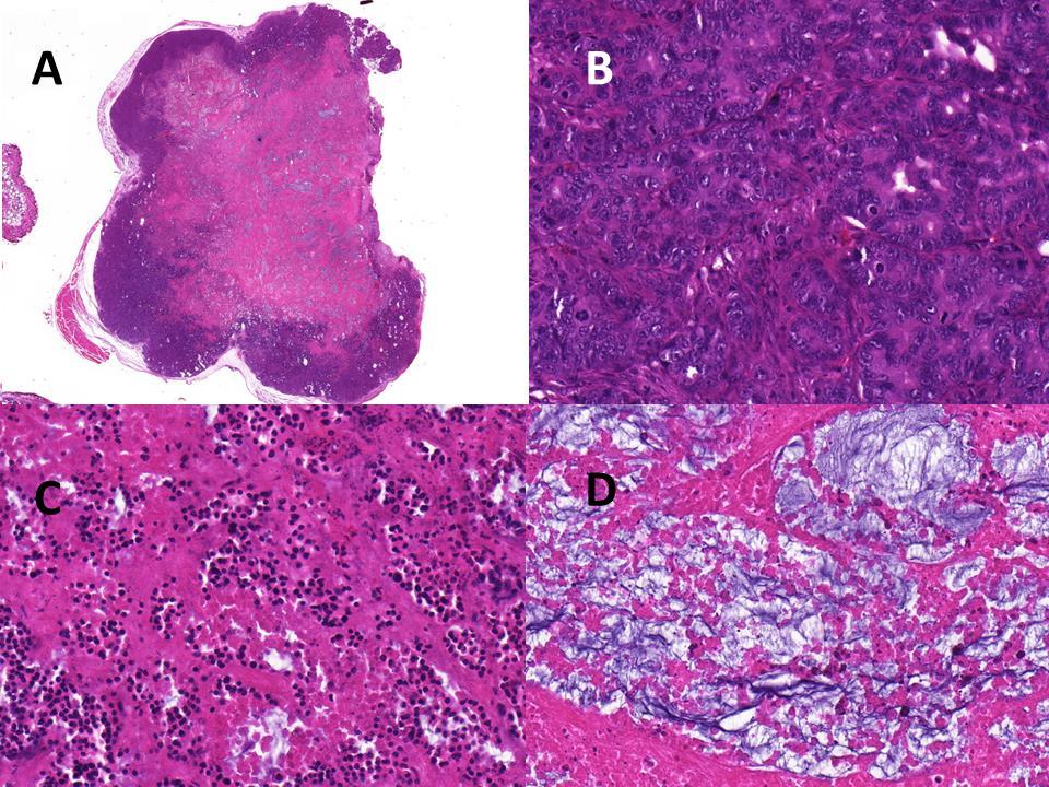 15. ábra. A xenograft-modellből származó tumor szövettani metszete hematoxilineozin festéssel. A teljes tumorszövet 5x nagyításban látható (A).