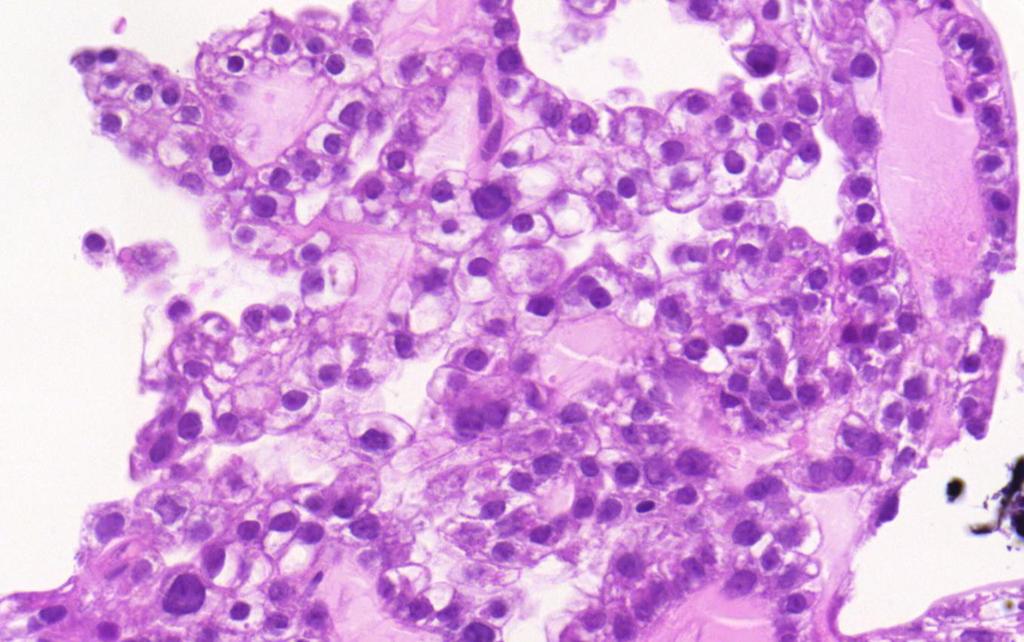 carcinoma