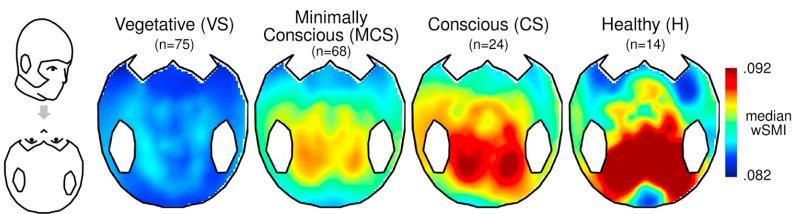 wsmi: weighted symbolic mutual information 2 EEG