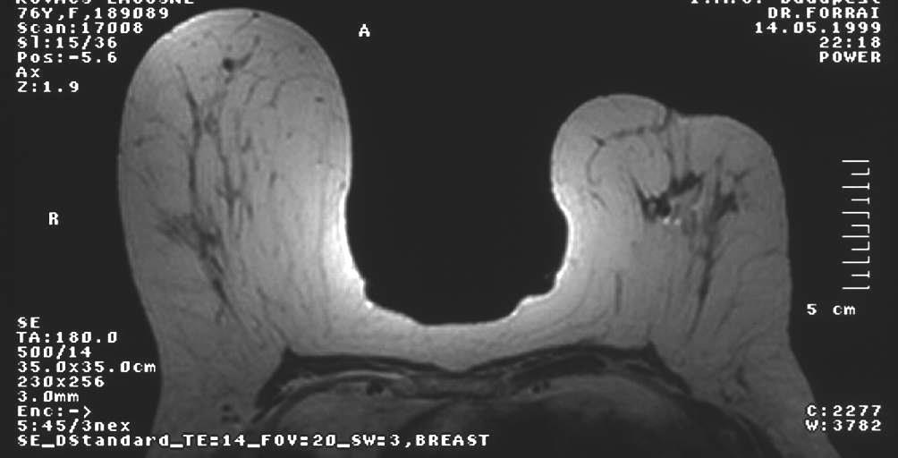 Értékelés T1: T2 Mammográfia jellegű kép, zsír +++ Ciszta