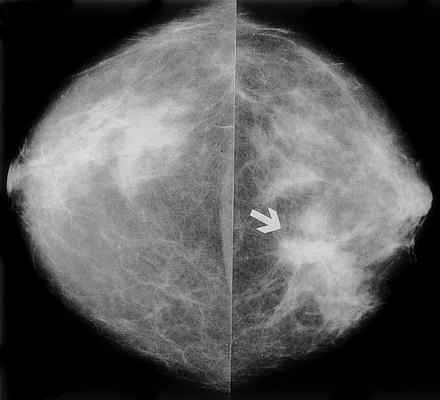 Conventional craniocaudal mammograms show two neighboring masses (arrow) with partially ill-defined and partially spiculated margins in