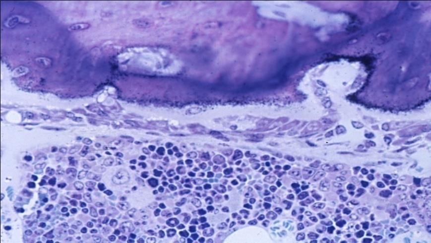 Biszfoszfonátok és Denosumab eloszlása különböző Bisphosphonates are adsorbed to bone surfaces at sites of bone turnover Denosumab circulates in blood and extracellular fluid including bone tissue