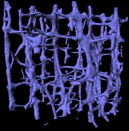 Csigolya kompresszióval kísért osteoporosis 84 éves nő A csonttömeg és