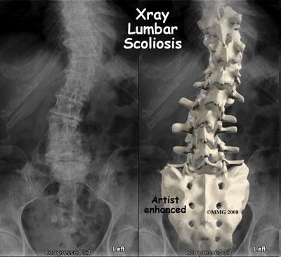 Scoliosis