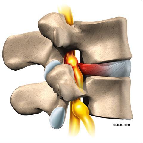 Discus hernia CV-CVI csigolyák között