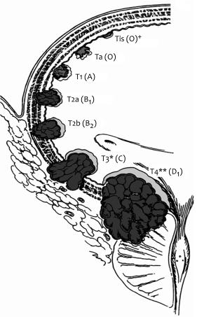 Romics Imre Schistosomiasis okozta hólyagdaganat T3 az izomzat mélyebb rétegét vagy a hólyag körüli (periveszikális) zsírszövetet infiltráló tumor T3a az izomzat mélyebb rétegét infiltráló tumor T3b