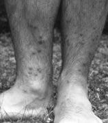 Romics Imre Schistosomiasis okozta hólyagdaganat 5. ábra Viszkető bőrgyulladás láthatók.