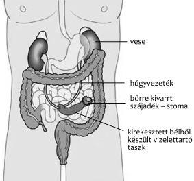 Hólyagtükrözés során gyulladást, a hólyag felszínéből kiemelkedő, exofitikus elváltozásokat találhatunk. Szövetminta-vizsgálat szó ba jöhet, ha kétséges a diagnózis.