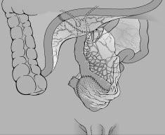 Mellékhatásként hányás, émelygés, máj károsodás, spermatogenesis gátlása, EKGeltérések jelentkezhetnek. Antibiotikumok adására is szükség lehet (Zaghloul, 2008).