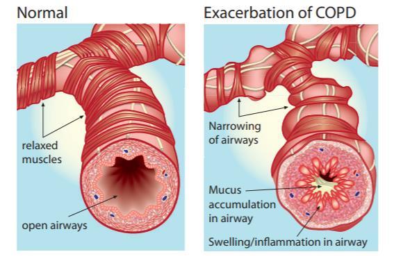 MI TÖRTÉNIK COPD EXACERBÁCIÓBAN?