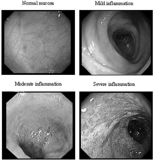 TUDOMÁNYOS FÓRUM Colitis ulcerosa endoscopos képe. Kép forrása: http://www.webbeteg.