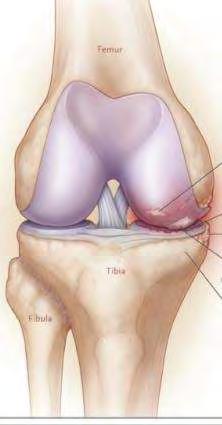 Az arthrosisra jellemző folyamatok Porcdestructio Ízületi rés szűkület Osteophyták Degenerált meniscus Sclerotikus csont, cysták Porc Proteoglycan tartalom inos, NO COX-2,